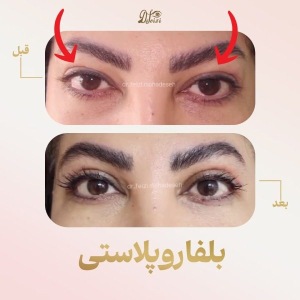 blepharoplasty-1