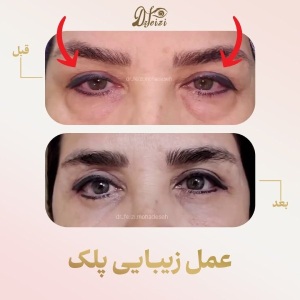blepharoplasty-2