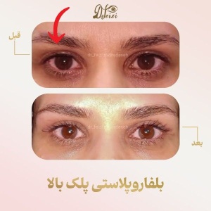 blepharoplasty-3