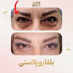 blepharoplasty-4