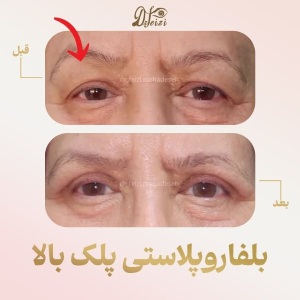 blepharoplasty-5