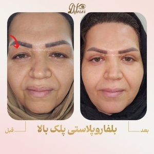 blepharoplasty-6
