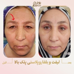 blepharoplasty-7