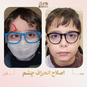 Strabismus-4