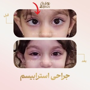 Strabismus-Surgery-1
