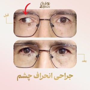 Strabismus-Surgery-2