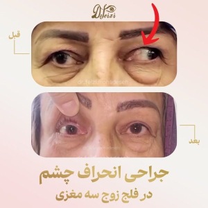 Strabismus-Surgery-3