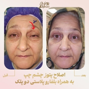 petosis-surgery-2