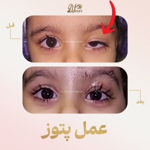 ptosis-1