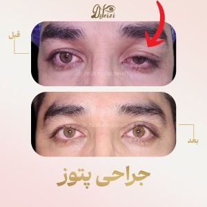 ptosis-2