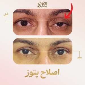 ptosis-3