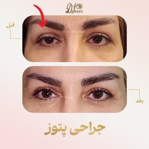 ptosis-4
