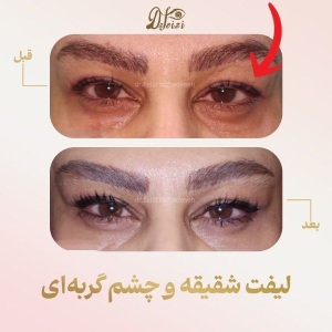 Canthoplasty-blepharoplasty-4-1