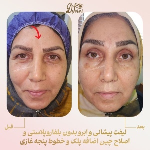 brow-and-forehead-lift-10