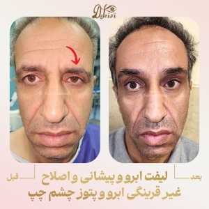 brow-and-forehead-lift-6