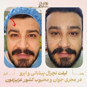 brow-and-forehead-lift-7