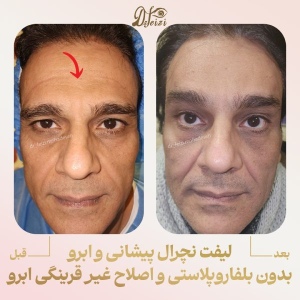brow-and-forehead-lift-8