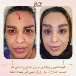 brow-and-forehead-lift-9