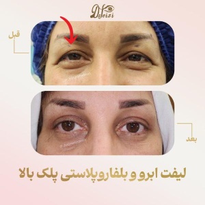 brow-lift-and-blepharoplasty-11