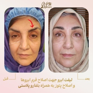 brow-lift-and-blepharoplasty