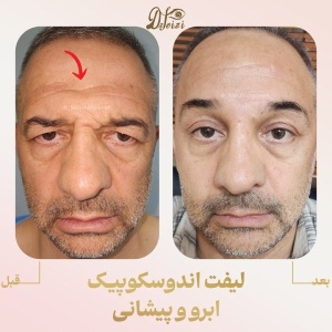 endoscopic-brow-and-forehead-lift-1
