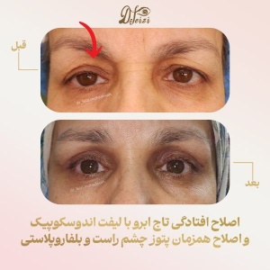 endoscopic-brow-lift-and-blepharoplasty
