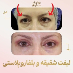 temporal-lift-blepharoplasty-1