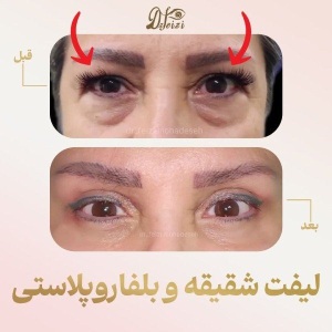 temporal-lift-blepharoplasty-2