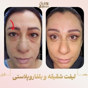 temporal-lift-blepharoplasty-3