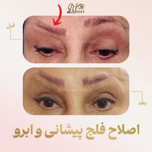 Correction-of-Forehead-and-Brow-Paralysis-1
