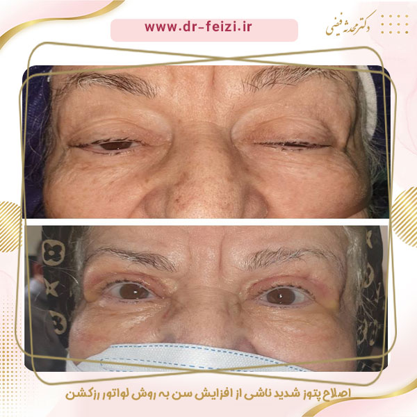پتوز - دکتر محدثه فیضی