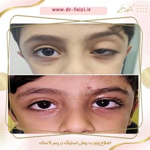 پتوز کودکان - دکتر محدثه فیضی