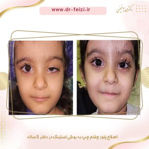 پتوز کودکان - دکتر محدثه فیضی