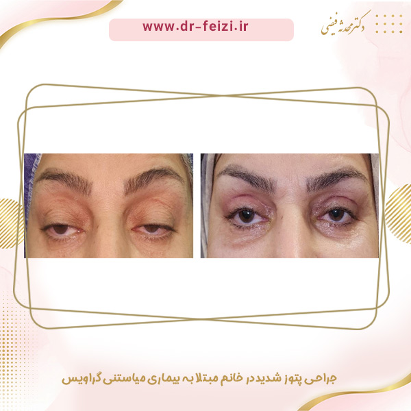 پتوز - دکتر محدثه فیضی