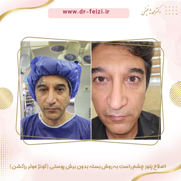 جراحی پتوز - دکتر فیضی