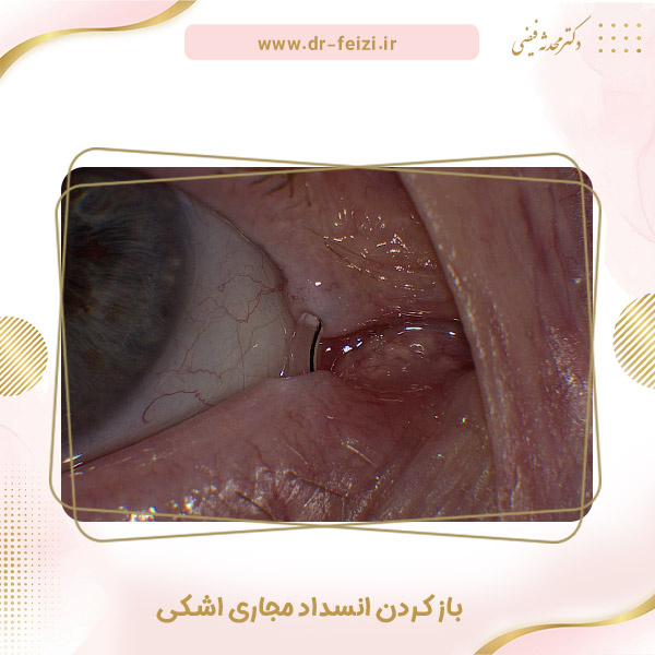 باز کردن انسداد مجاری اشکی - دکتر فیضی