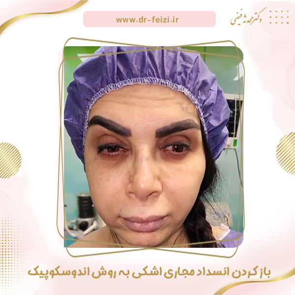 باز کردن انسداد مجاری اشکی - دکتر فیضی