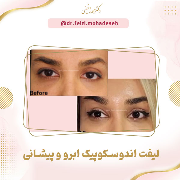 لیفت اندوسکوپیک ابرو و پیشانی - دکتر محدثه فیضی