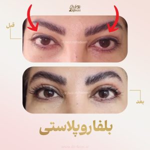قبل و بعد جراحی زیبایی پلک