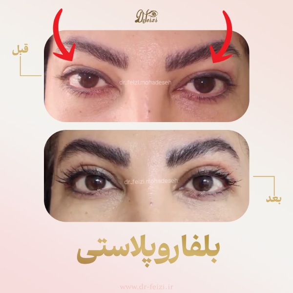 قبل و بعد جراحی زیبایی پلک