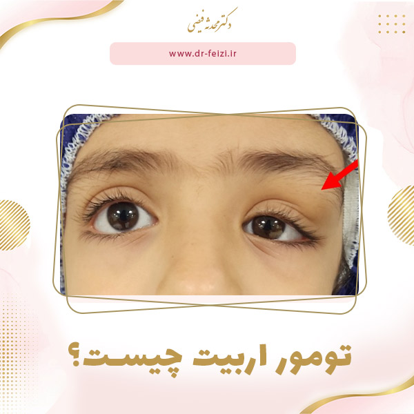 عکس تومور اربیت