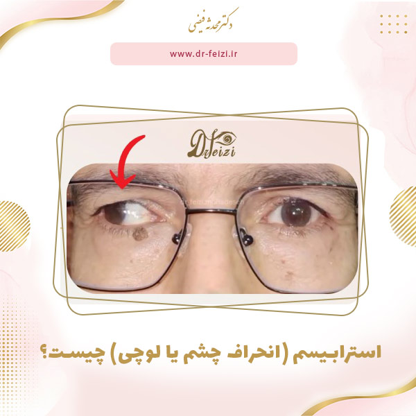 استرابیسم (انحراف چشم یا لوچی) چیست؟ (علت و انواع)