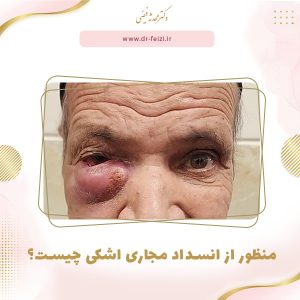 عکس انسداد مجرای اشکی