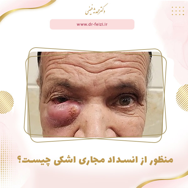 عکس انسداد مجرای اشکی