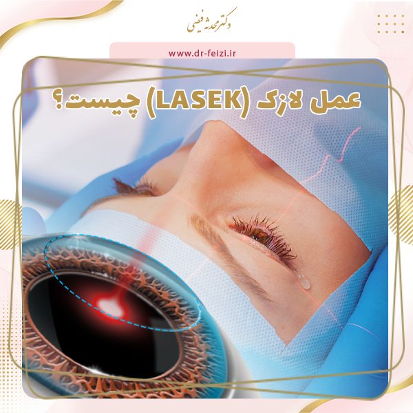 عمل لازک (LASEK) چیست؟ کاربرد و مزایا و کاندید مناسب عمل لازک