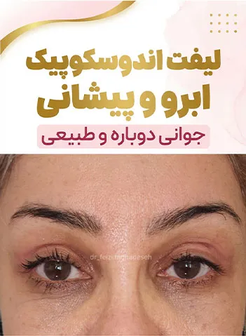 لیفت ابرو و پیشانی دکتر محدثه فیضی -dr-feizi.ir