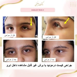 کیست درموئید چشم