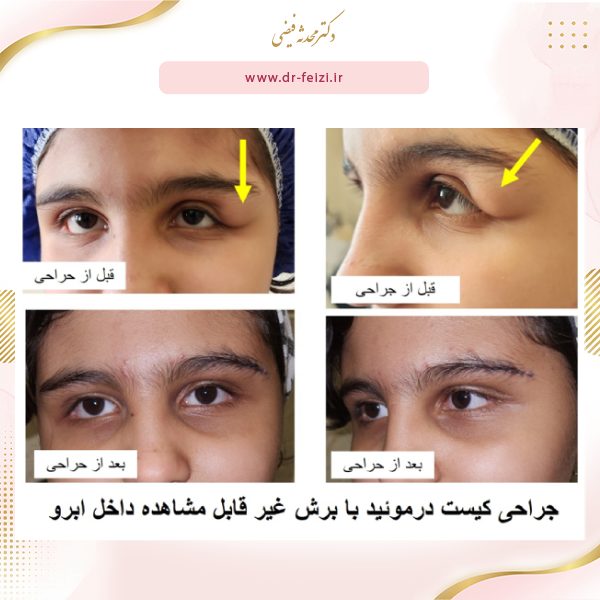 کیست درموئید چشم