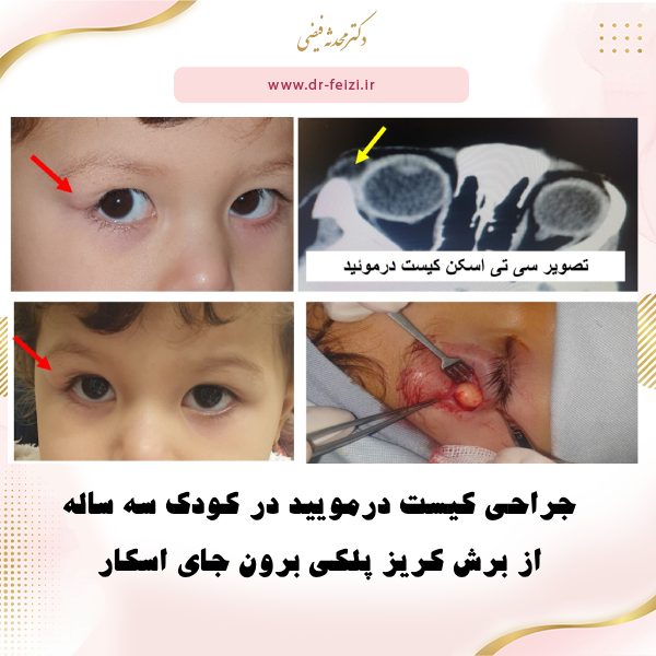 کیست درمویید در کودکان