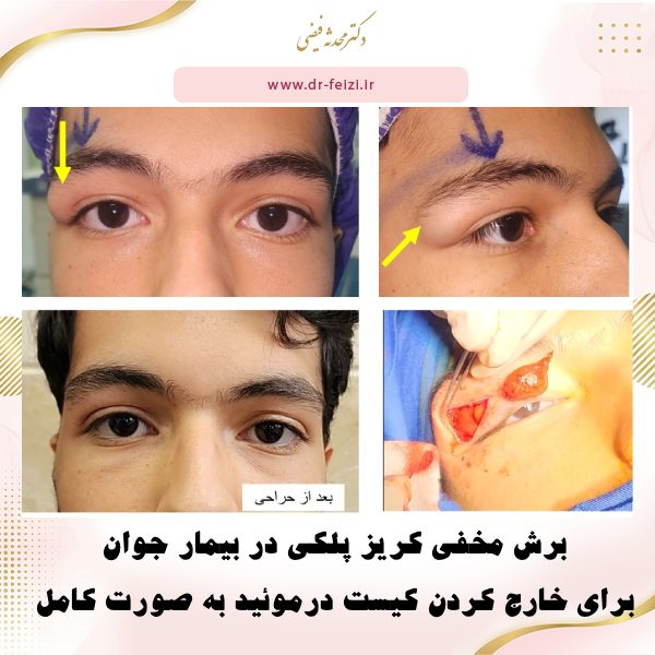 عمل جراحی کیست درموئید چشم